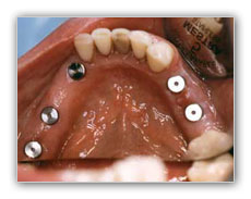 implantes sin cirugia