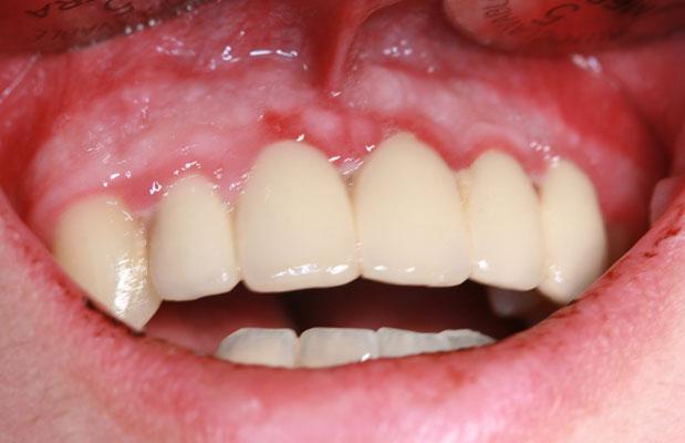 implantes por ordenador