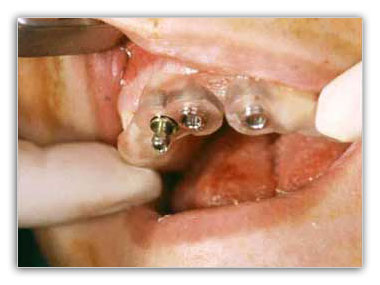 escaner bucal