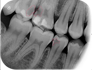 caries dental