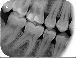 caries dental