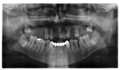 implantes por ordenador