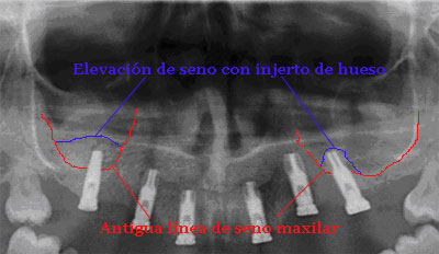 elevacion de seno