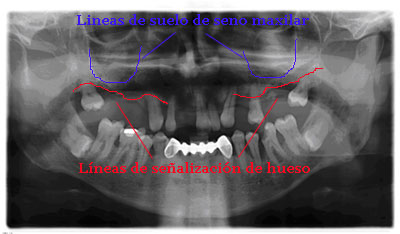 implantes por ordenador